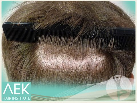 FUE Hair Transplant Surgery in Turkey Istanbul