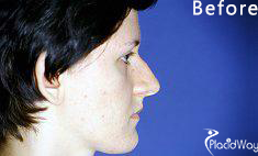 Before Picture Nose Surgery Croatia