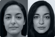 Before And After Nose Surgery Turkey