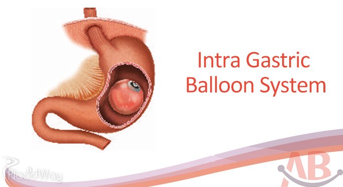 Intra Gastric Baloon System Bariatric Surgery Ahmedabad India