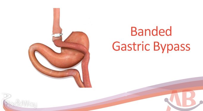 Banded Gastric Bypass in India