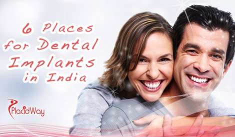  6 Places for Affordable Dental Implants in India