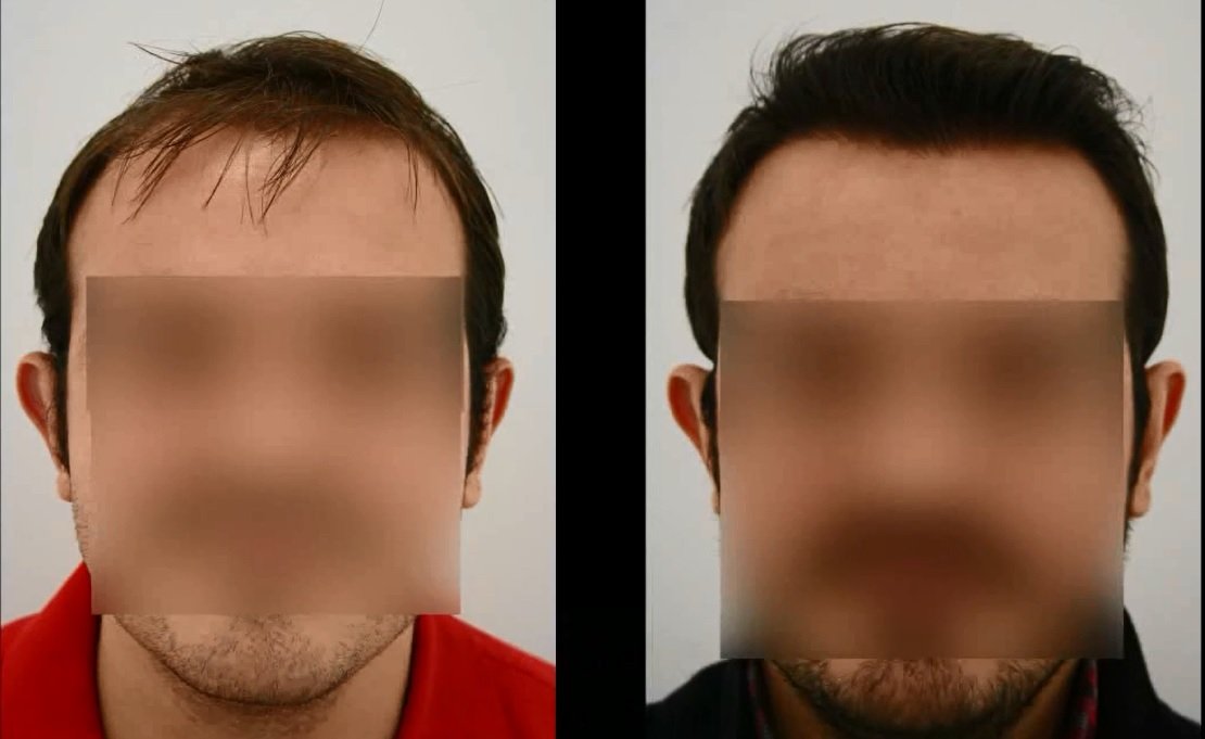 Hair Transplant Before and After