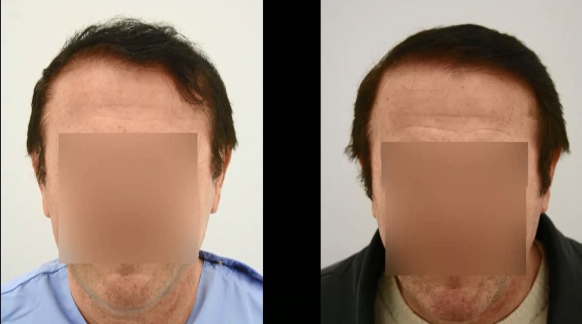 FUE Hair Transplant Before and After Turkey