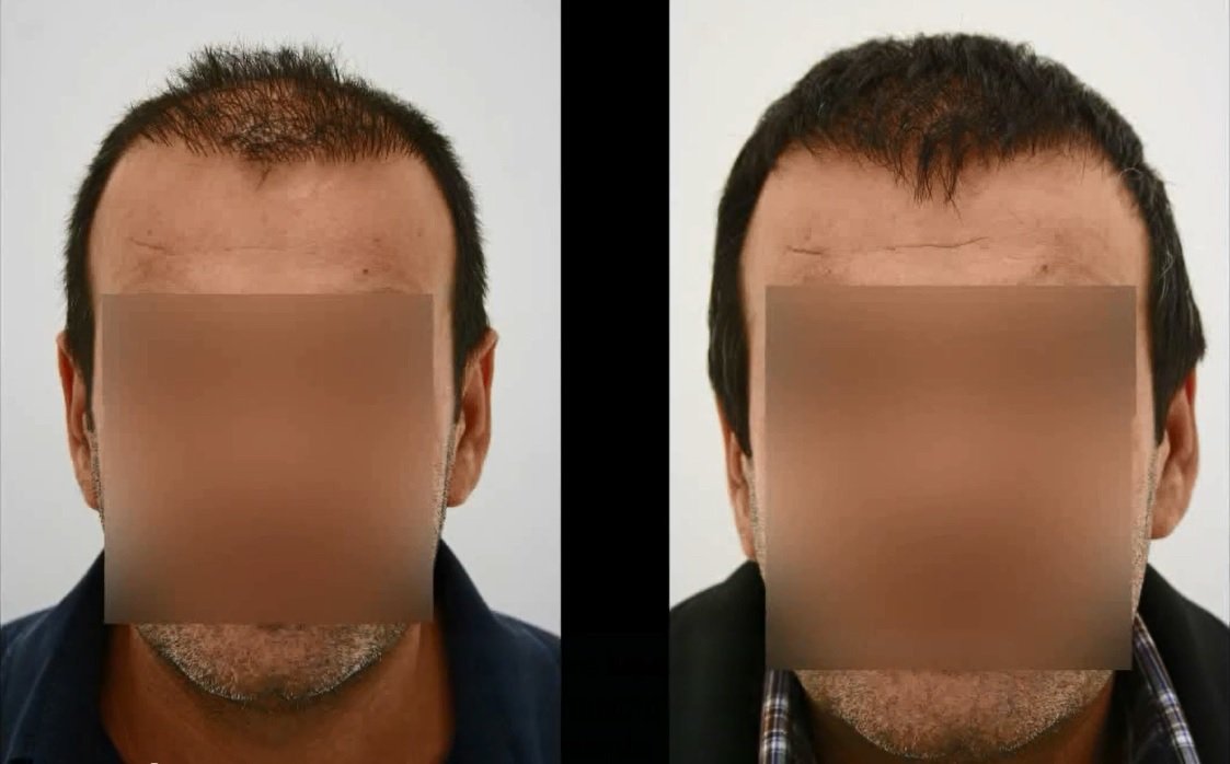FUT Hair Transplant Before and After Turkey