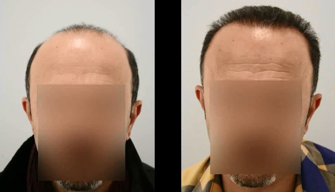 Hair Transplantation Before and After Istanbul Turkey