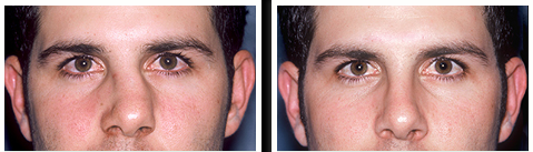 Before and After Nose Surgery Procedure Mexico