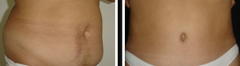 Before and After Picture Tummy Tuck