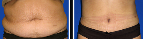 Abdominoplasty Before and After Pictures