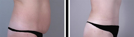 Tummy Tuck Before and After Image