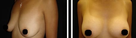 Breast Augmentation Before and After Pictures