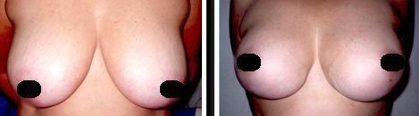 Mexico Breast Implants Before and After Pictures