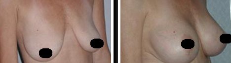 Mexico Breast Lift Before and After Images