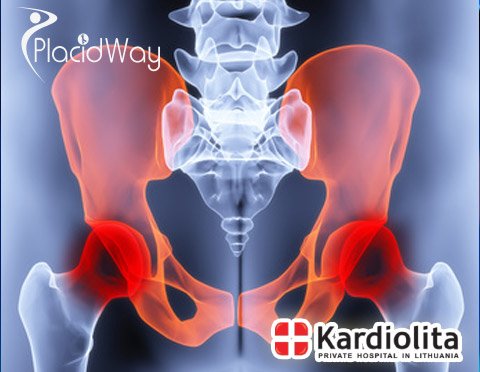Hip Replacement in Lithuania - PlacidWay Medical Tourism