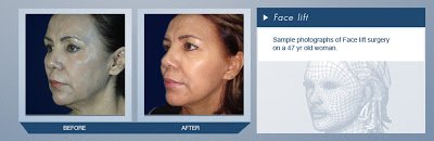 Face Lift Procedure in Mexico Before and After Pictures