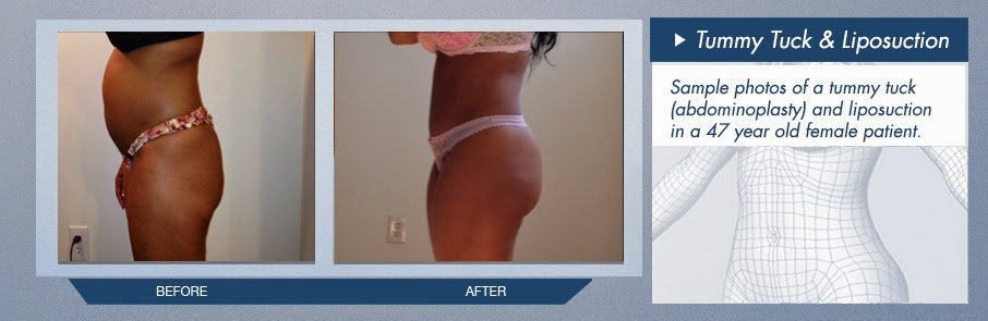 Tummy Tuck & Liposuction Before and After Images