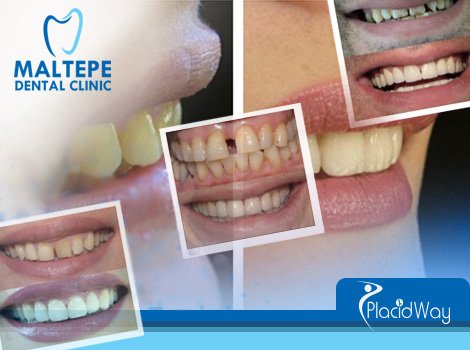Before & After Pictures - Dental Treatments Turkey