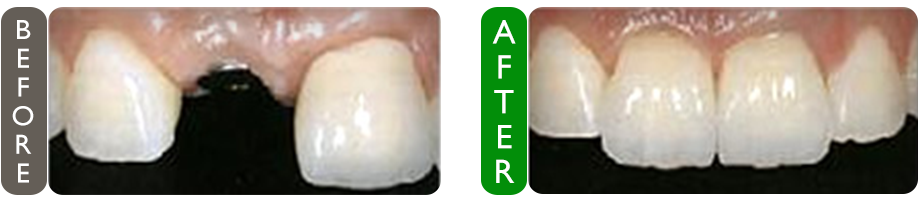before and after dental implant placement croatia image