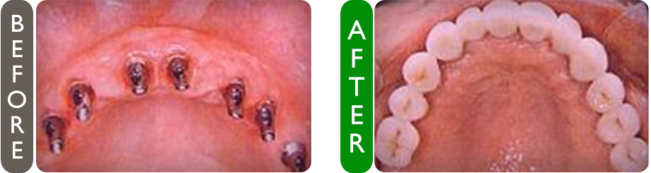 before and after dental implants placement croatia image