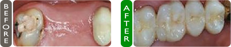before and after dental bridge placement croatia image