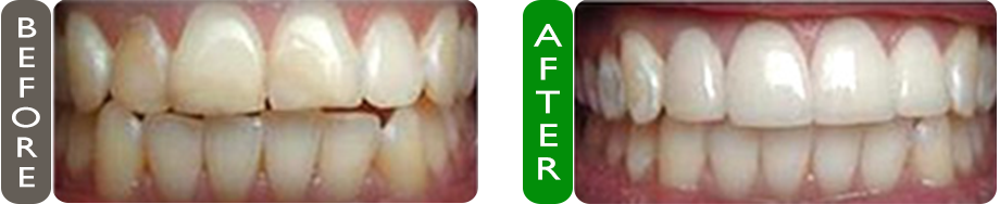 before and after dental veneers in croatia image