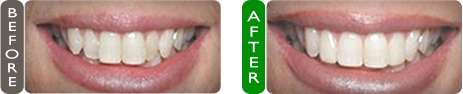 before and after dental veneers placement croatia smile image
