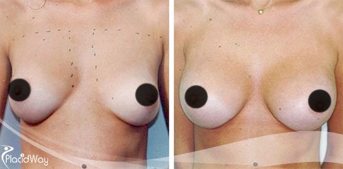 Breast Augmentation before and After Argentina