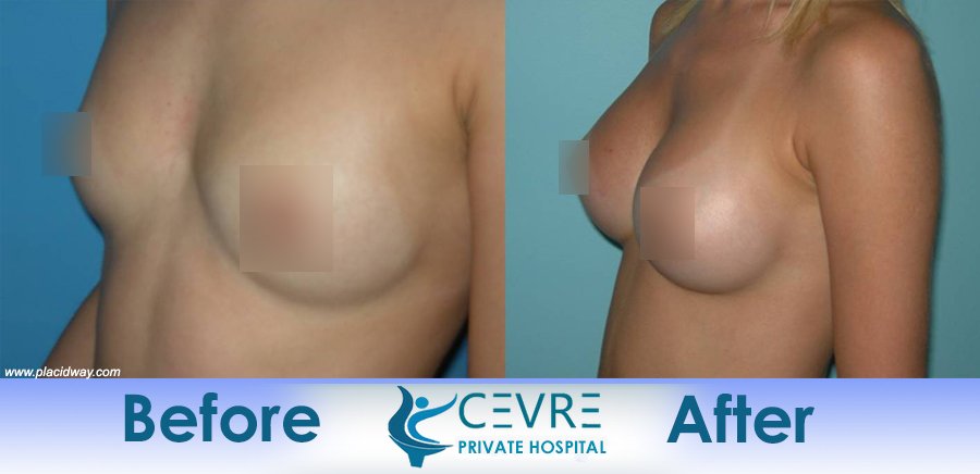 before and after breast augmentation in turkey cevre private hospital placidway image