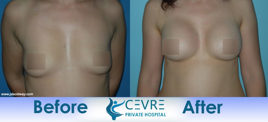 before and after breast implants in turkey cevre private hospital placidway image