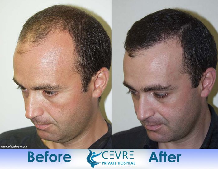 Before and After Hair Transplantation | Turkey FUE Istanbul