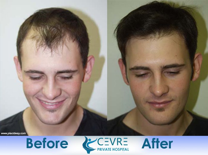 before and after hair transplant surgery in turkey cevre istanbul placidway image2