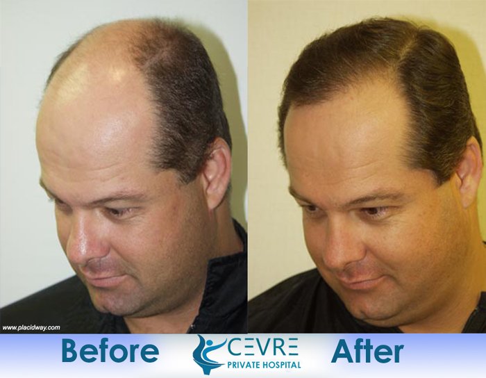 before and after hair transplant surgery in turkey cevre istanbul placidway image3