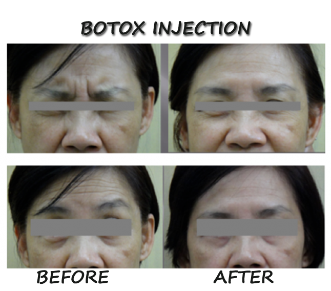 Before and After Botox Injections Pictures