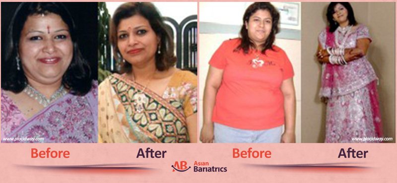 before after bariatric surgery in india women after obesity procedure in ahmedabad by asian bariatrics