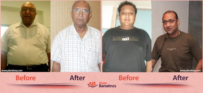 before after bariatric surgery in india men image obesity procedure in ahmedabad by asian bariatrics