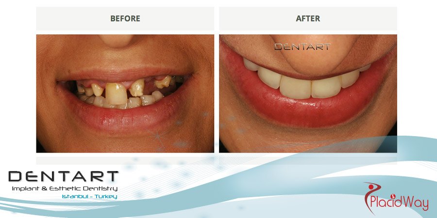 After Dental Implants in Turkey - Dentart Dental Clinic Istanbul
