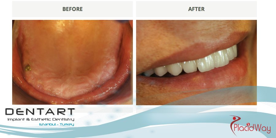 All on 4 dental implants before and after in Turkey