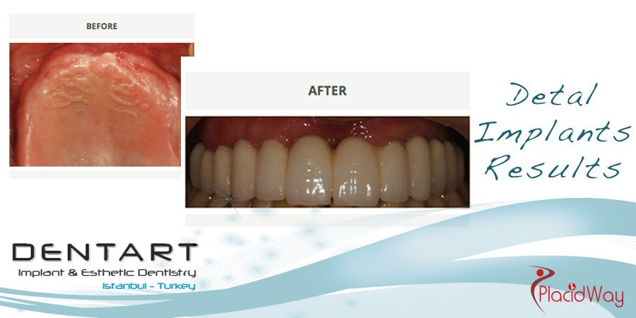 After Dental Implants Photos - Dentart Clinic - Turkey Medical Tourism