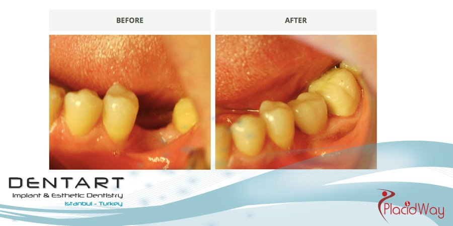 Dentistry Results in Turkey - Before and After Photos - Instanbul Medical Tourism