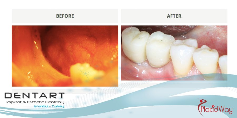 Dental Implants Before and After Pictures - Dental Tourism Turkey