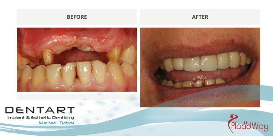 Patient Change with Dental Implants in Turkey - PlacidWay Medical Tourism