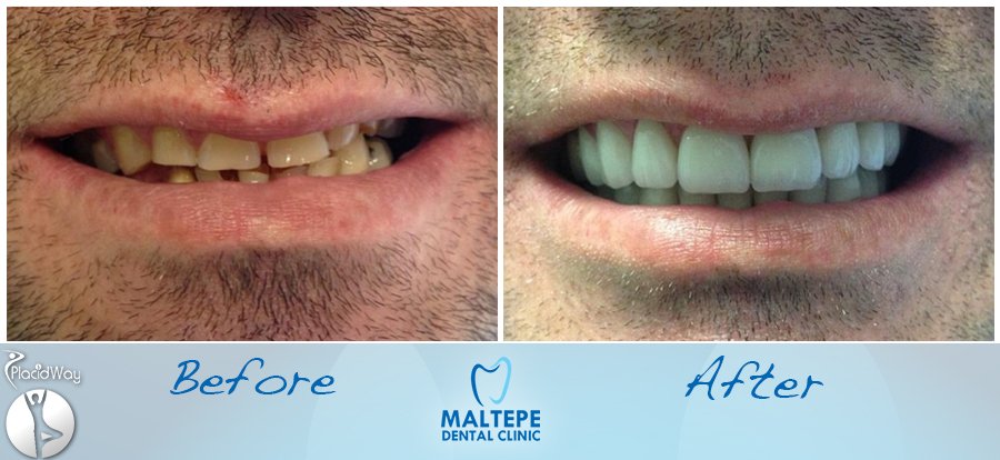 before and After Dental Veneers in Istanbul Turkey at Maltepe before-and-after-veneers-procedure-in-turkey-istanbul-image3