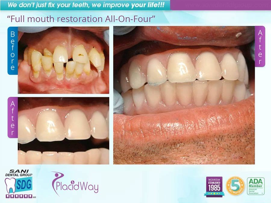 All-on-four - Full Mouth Restoration Testimonial - Los Algodones Mexico