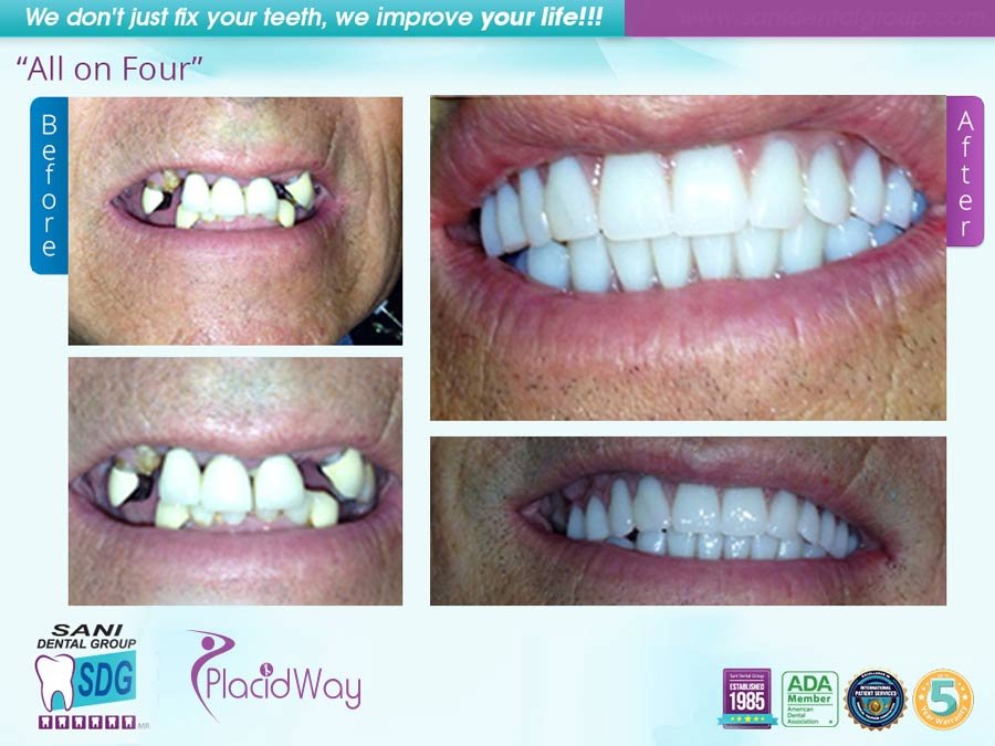 Before & After- All-on-four-Dental Implant