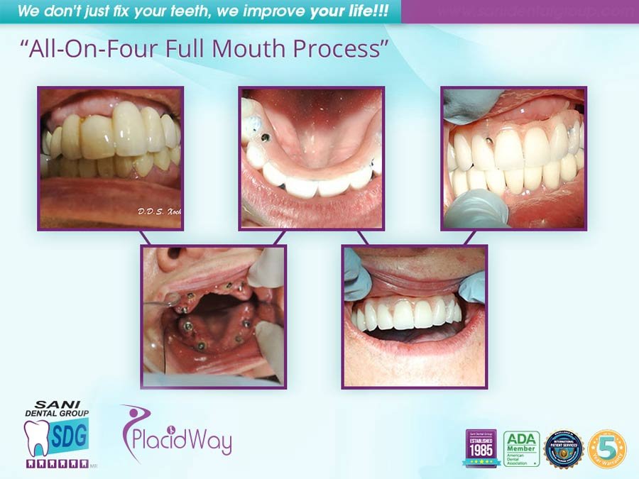 Before & After All On Four Mouth Process - Los Algodones Mexico