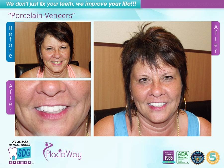 Before After Porcelain Veneers Testimonial in Los Algodones Mexico