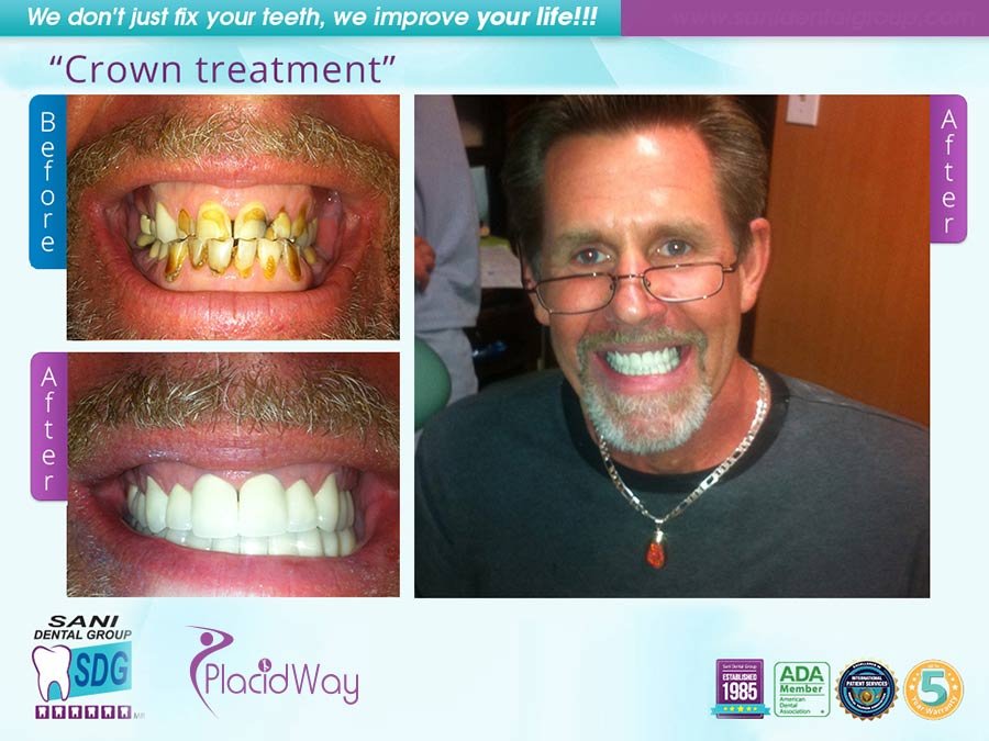 Before After Dental Crowns in Los Algodones Mexico