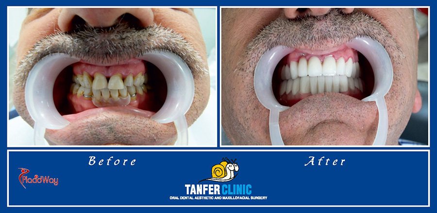 Dental Implants and Zirconium Porcelain Crowns in Turkey 