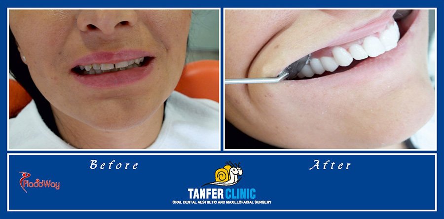 Dentistry Turkey Dental Implants
