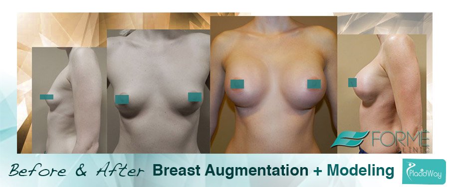 After Breast Implants Surgery - Europe